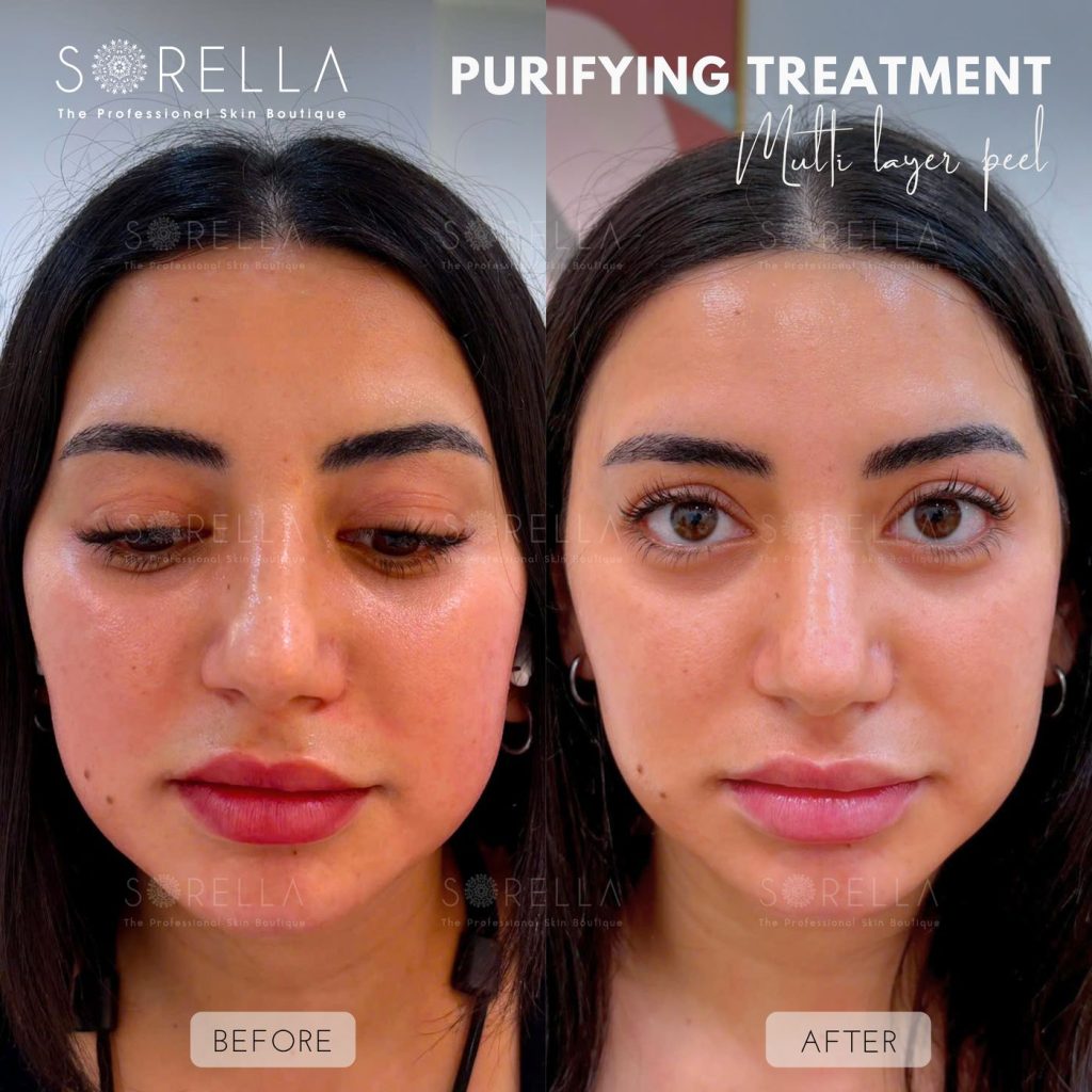 Before and after: Purifying Treatment – Multi layer peel at Sorella