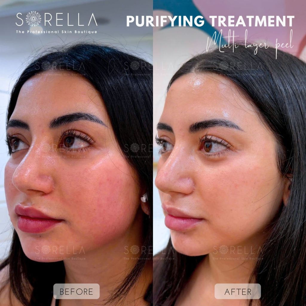 Before and after: Purifying Treatment – Multi layer peel at Sorella