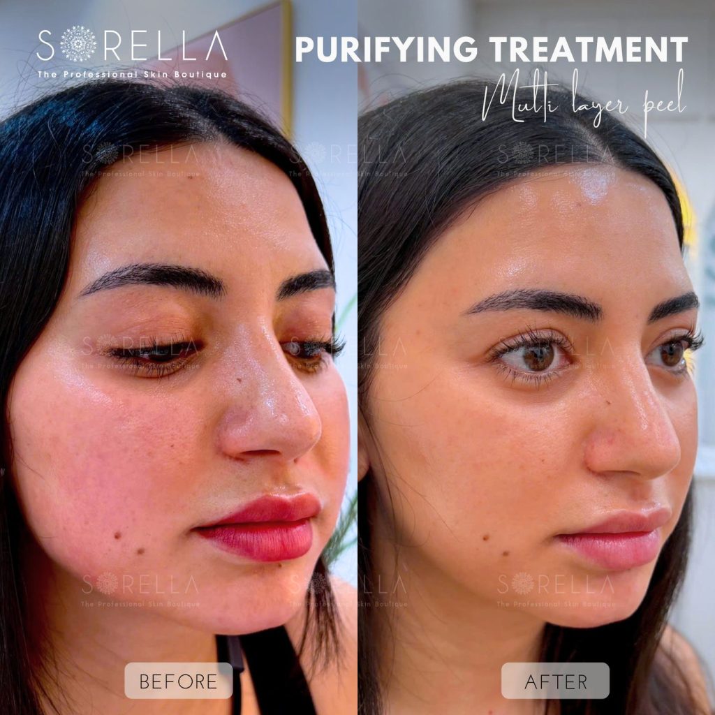 Before and after: Purifying Treatment – Multi layer peel at Sorella