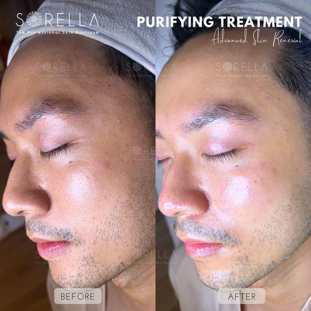 Before and after: Purifying Treatment at Sorella