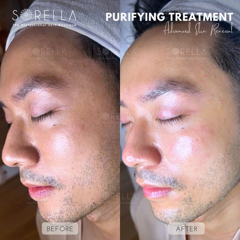 Purifying Treatment - before and after 6