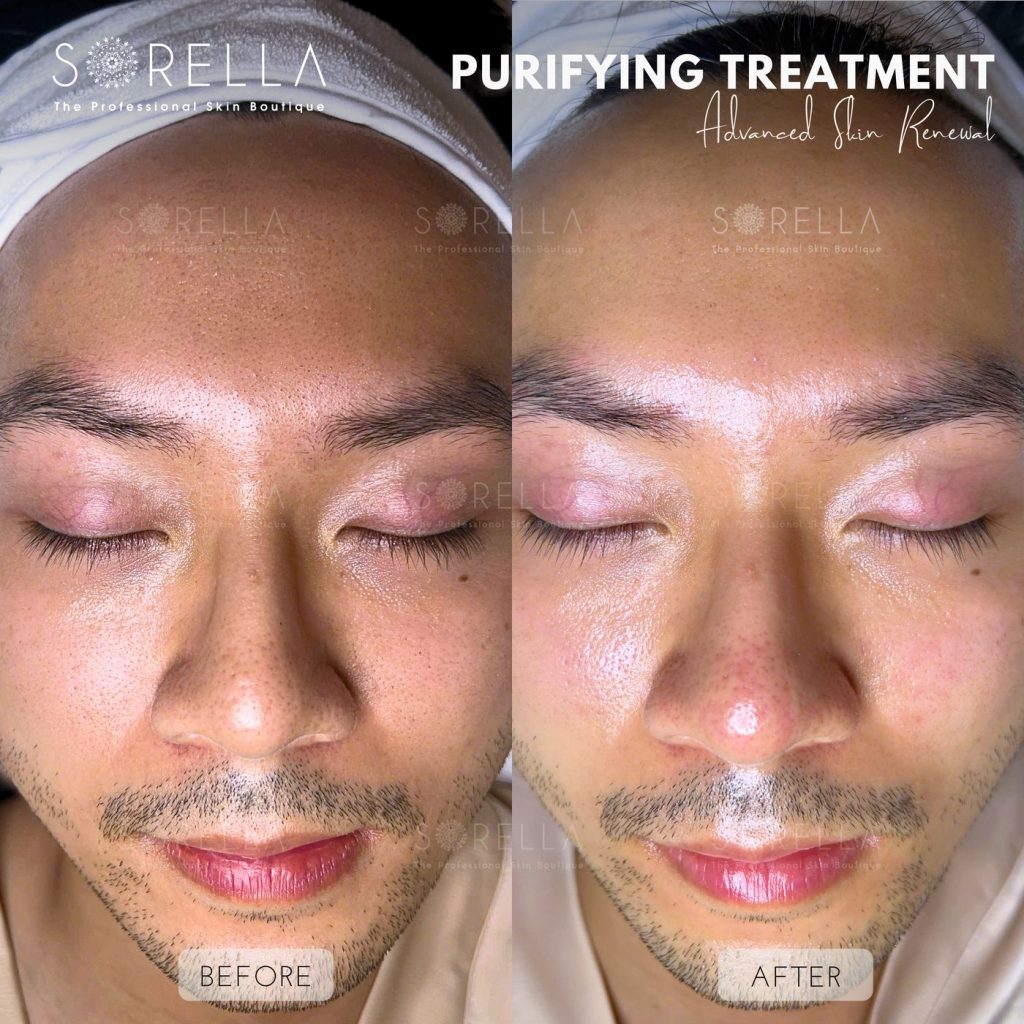 Before and after: Purifying Treatment at Sorella