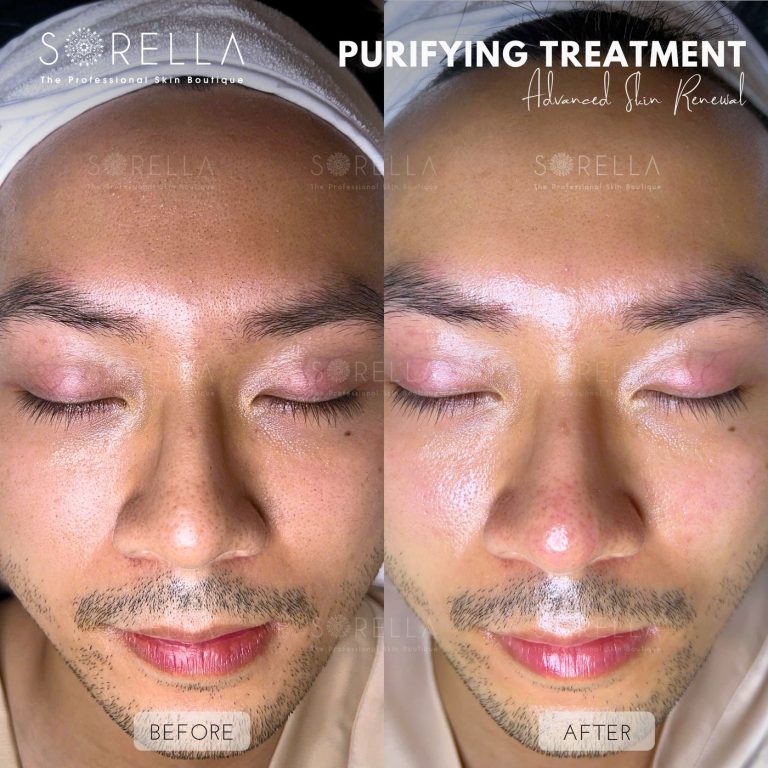 Purifying Treatment - before and after 7