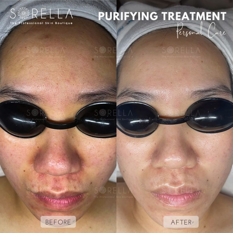 Purifying Treatment - before and after 8