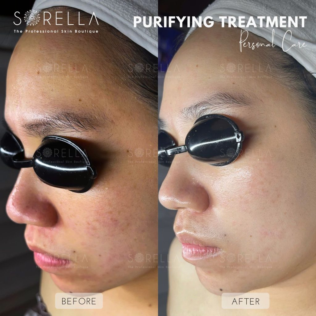 Before and after: Purifying Treatment at Sorella
