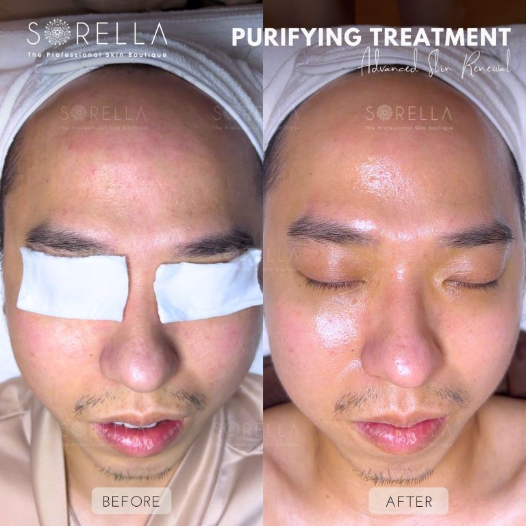 Purifying Treatment - before and after 10