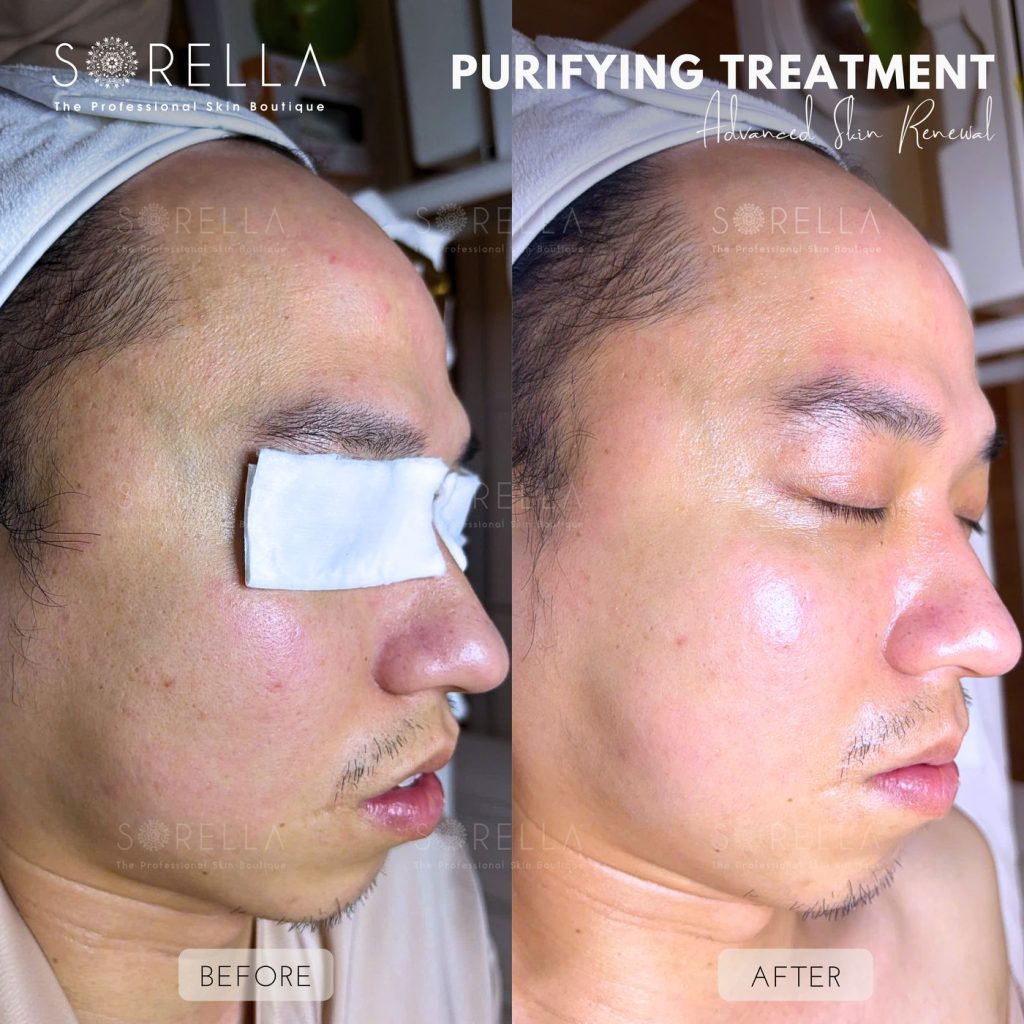 Before and after: Purifying Treatment at Sorella