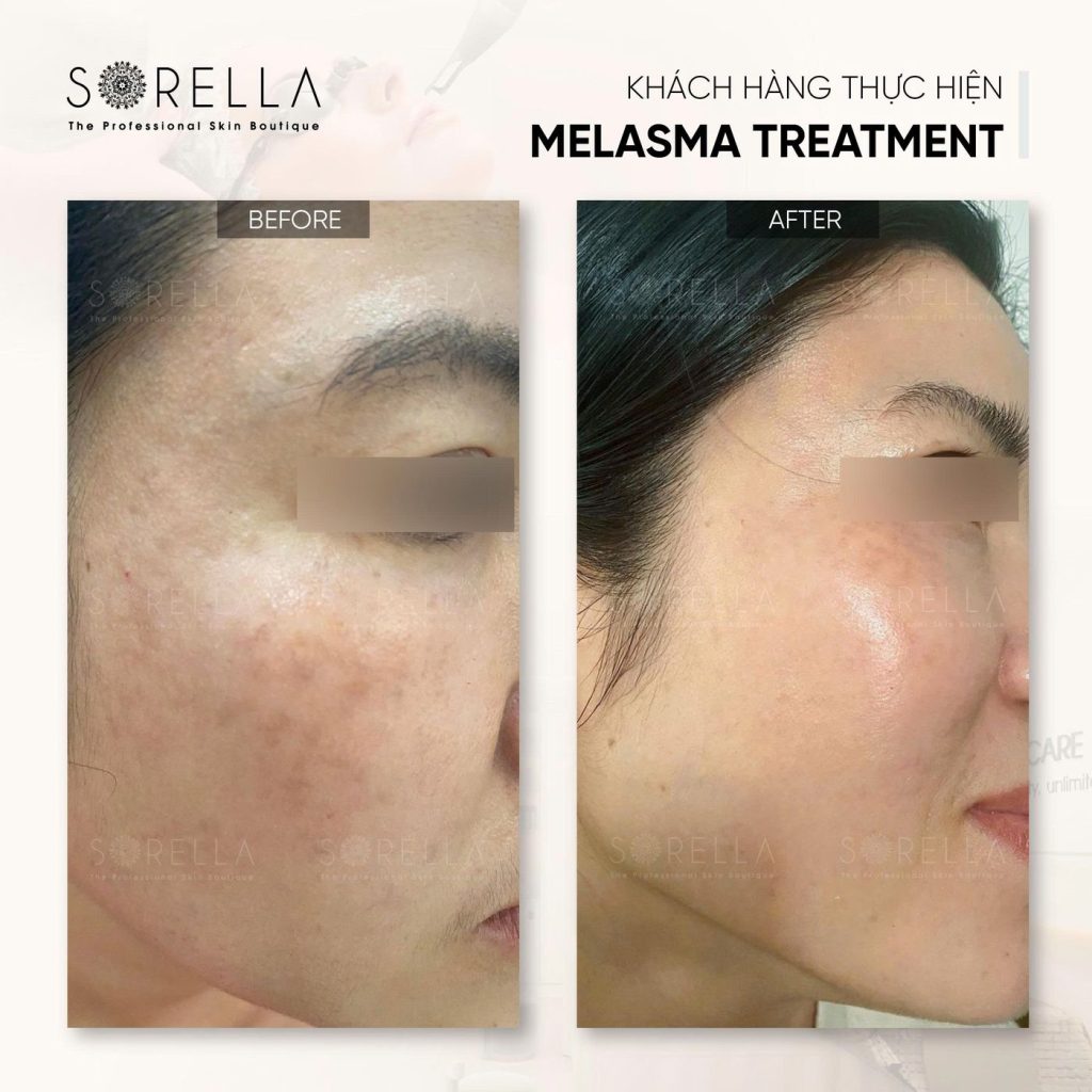 Before and after: Melasma Treatment at Sorella