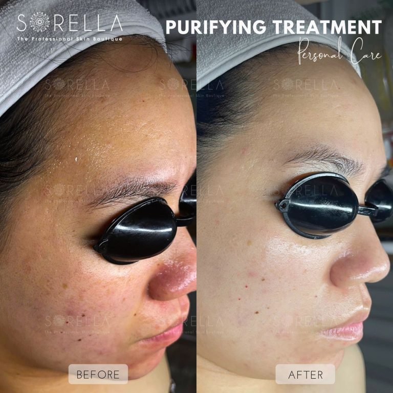 Purifying Treatment - before and after 12