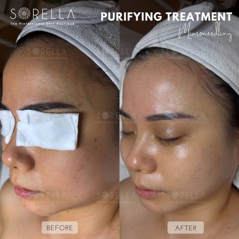 Purifying Treatment - before and after 14