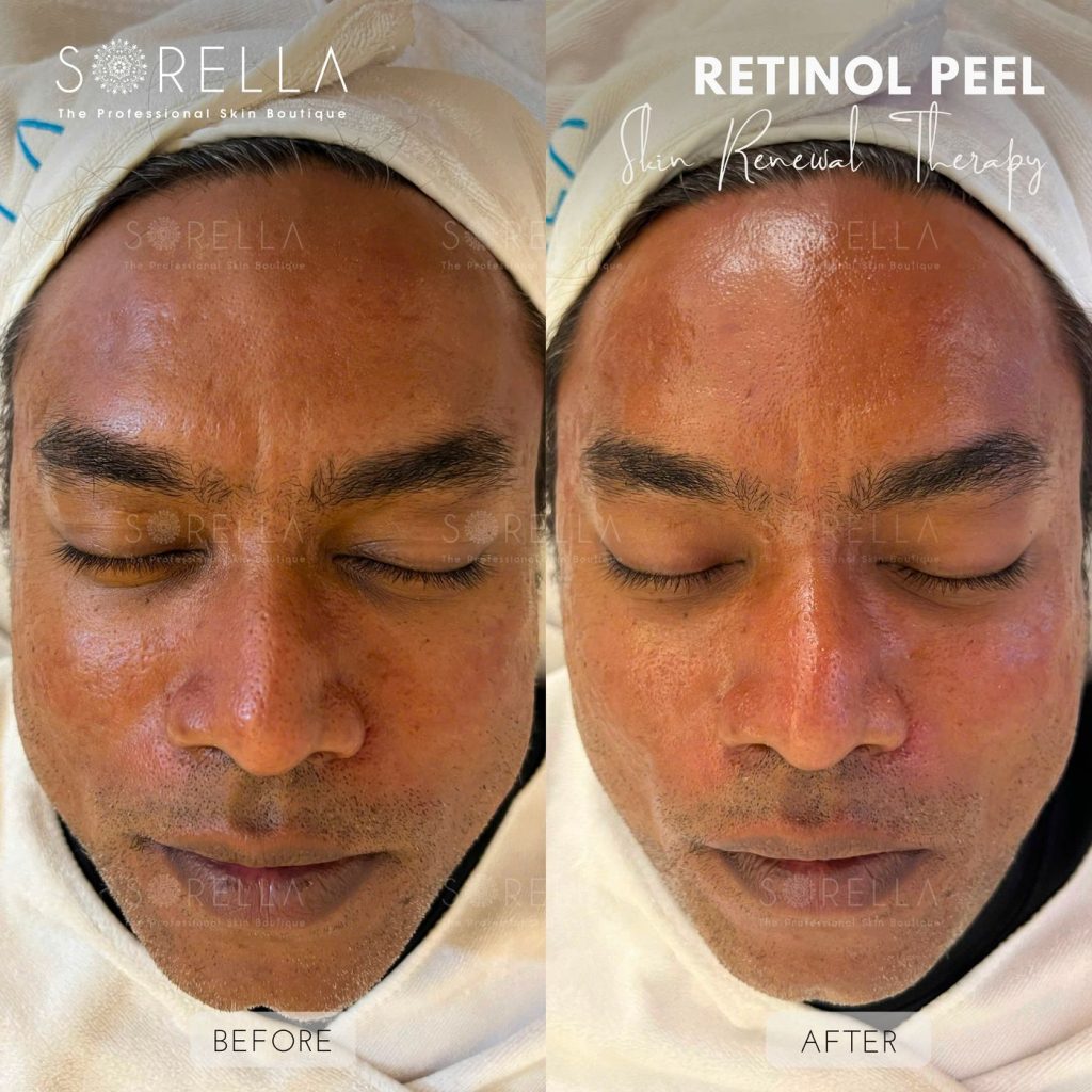 Before and after: Retinol Peel at Sorella