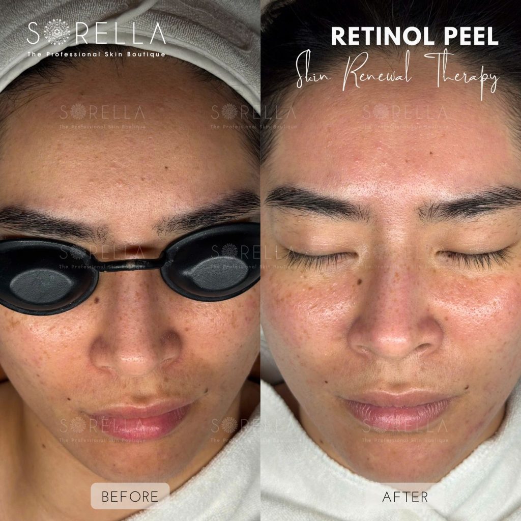 Before and after: Retinol Peel at Sorella