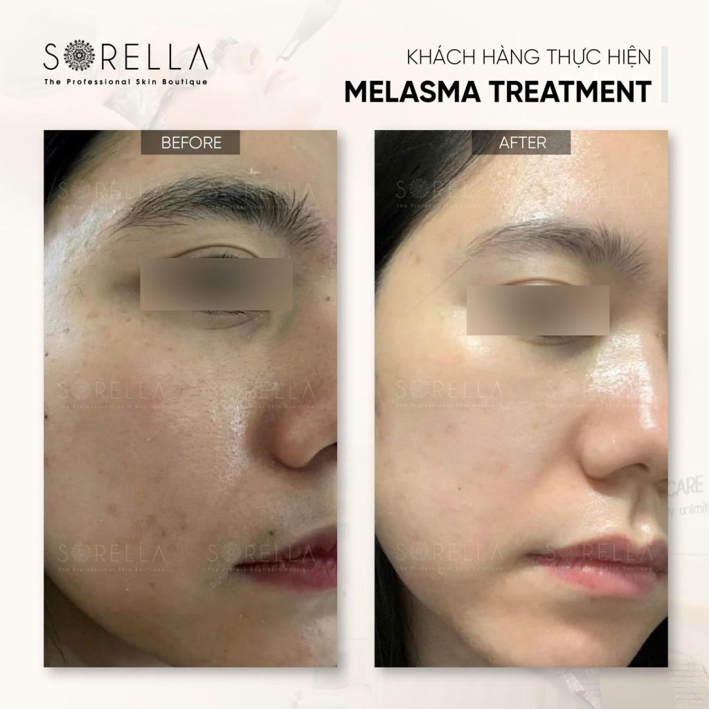 Before and after: Melasma Treatment at Sorella