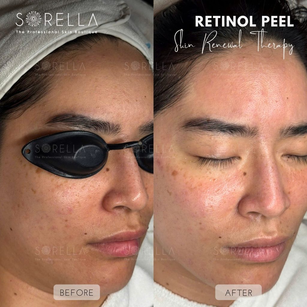 Before and after: Retinol Peel at Sorella