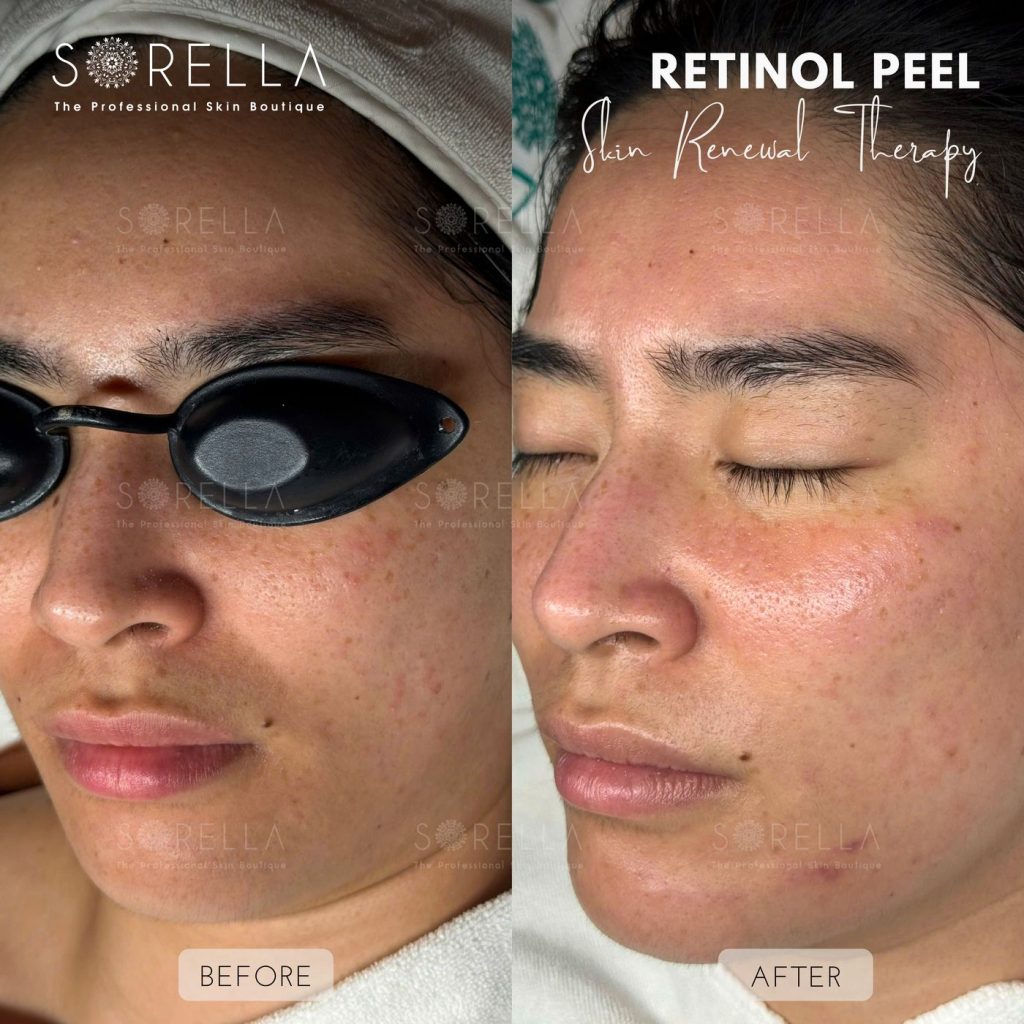 Before and after: Retinol Peel at Sorella