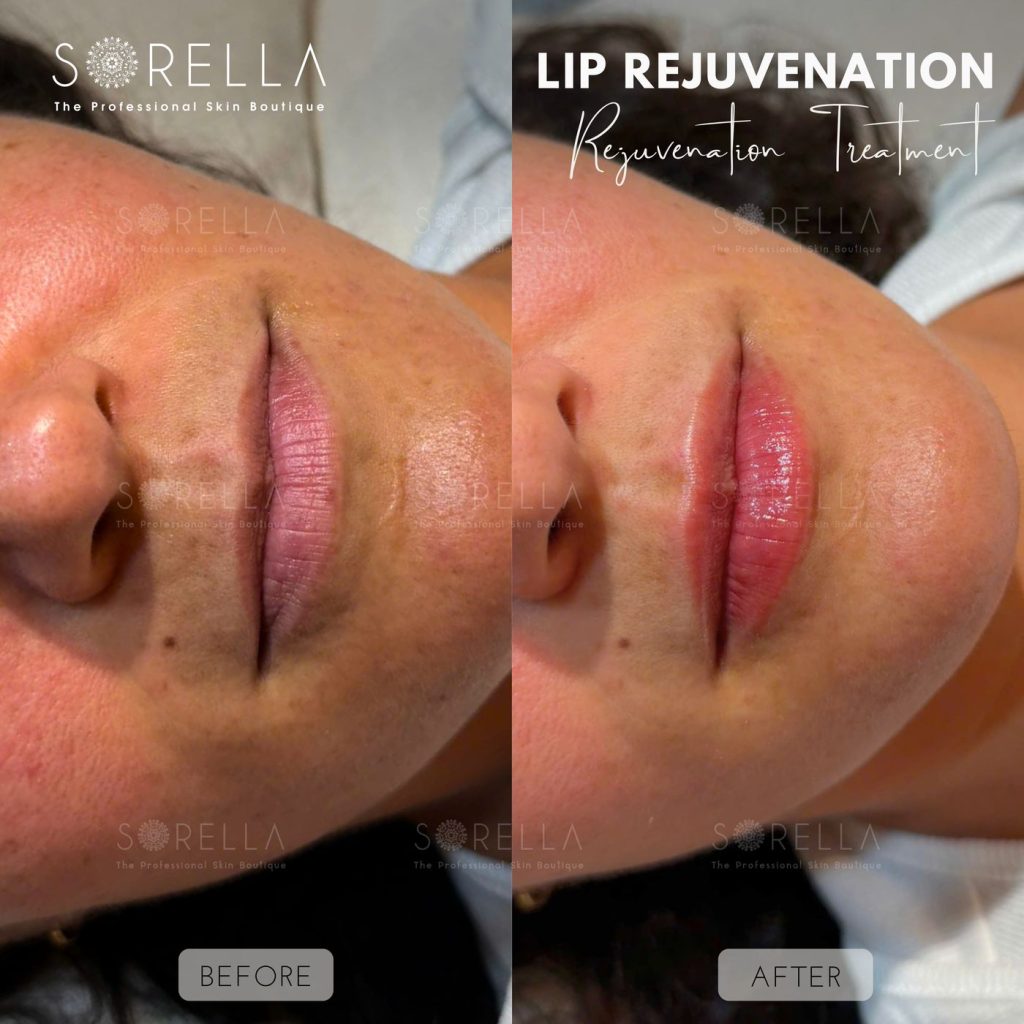 Before and after: Lip Rejuvenation at Sorella