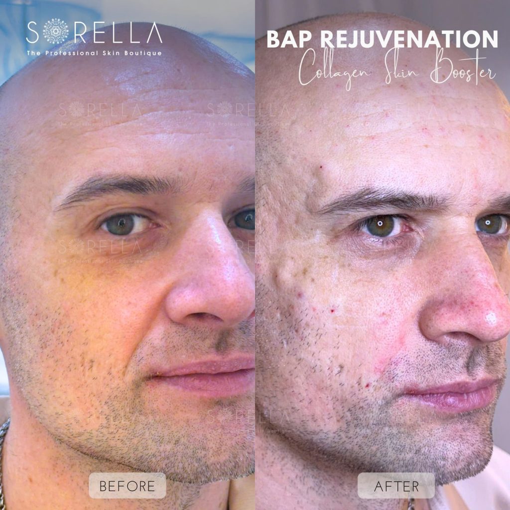 Before and after: BAP Rejuvenation – Collagen Skin Booster at Sorella