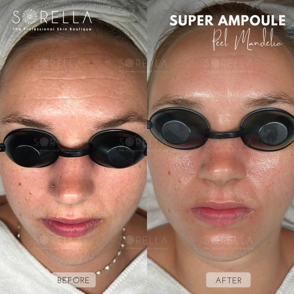 Before and after: Super Ampoule at Sorella