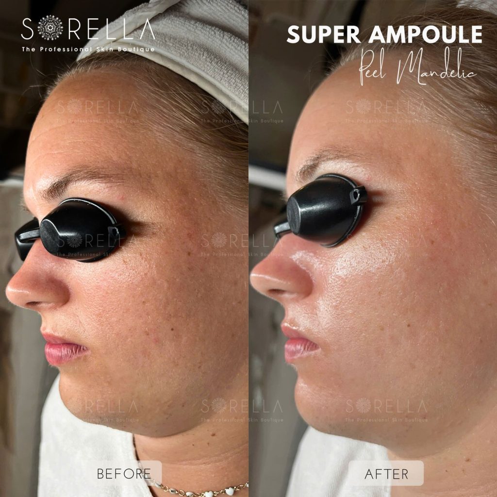 Before and after: Super Ampoule at Sorella