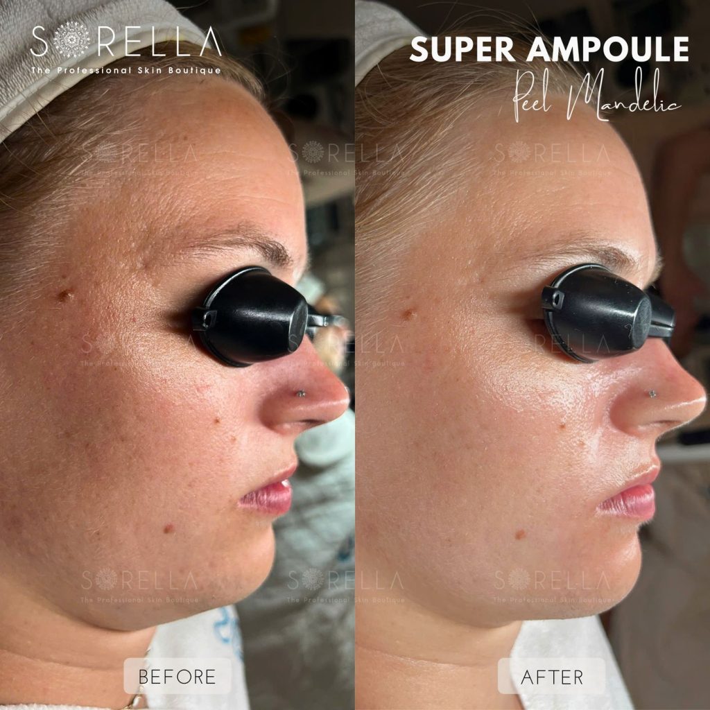 Before and after: Super Ampoule at Sorella