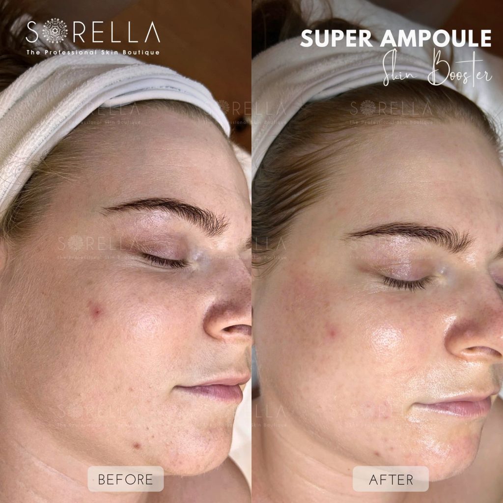 Before and after: Super Ampoule at Sorella