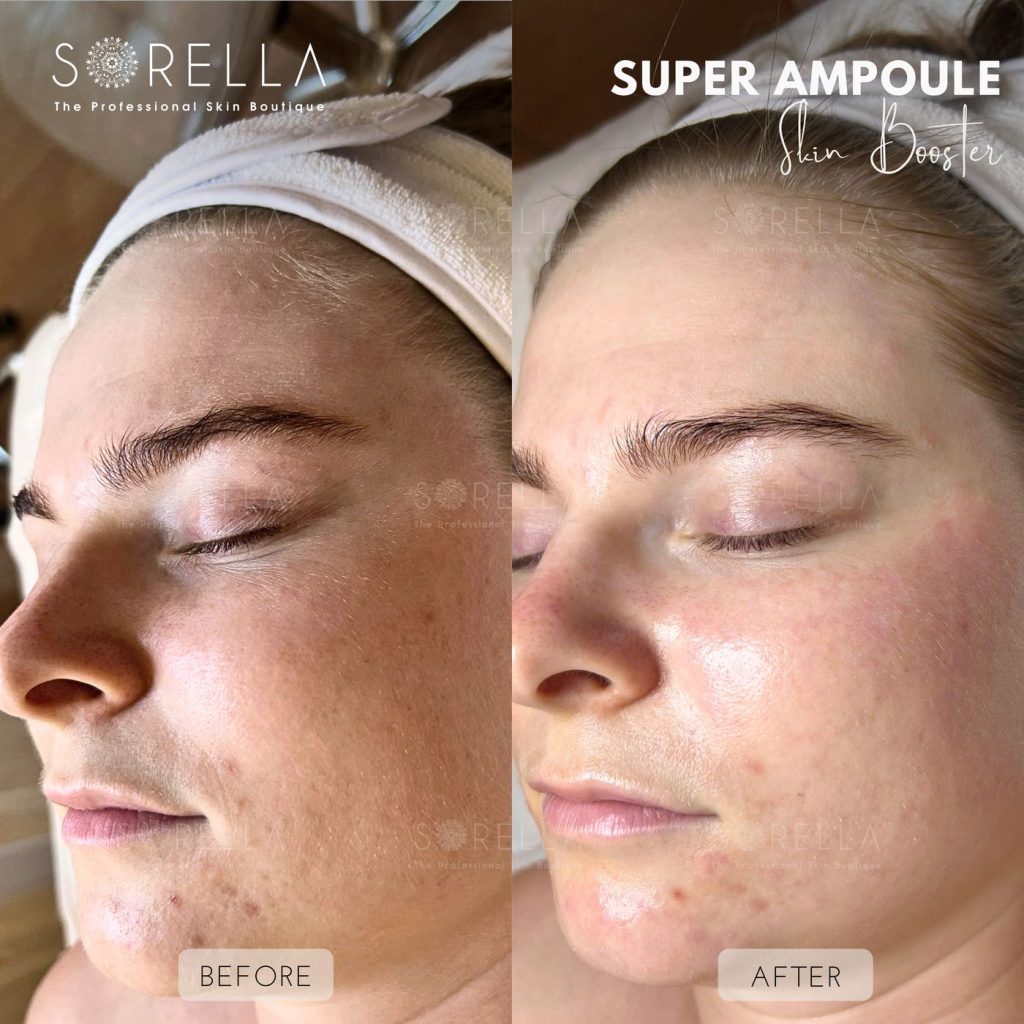 Before and after: Super Ampoule at Sorella