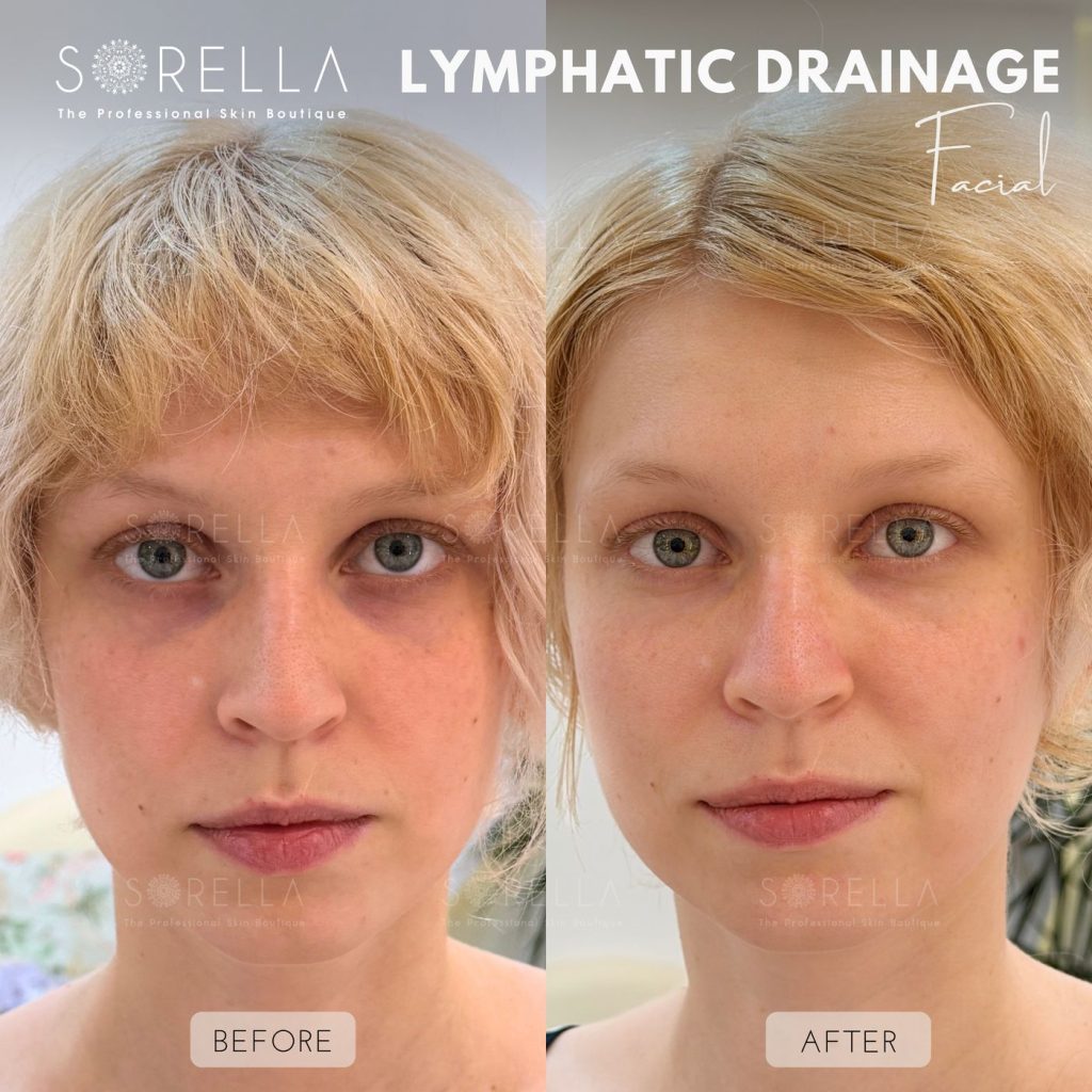 Before and after: Lymphatic Drainage Facial / Thanh Diện at Sorella