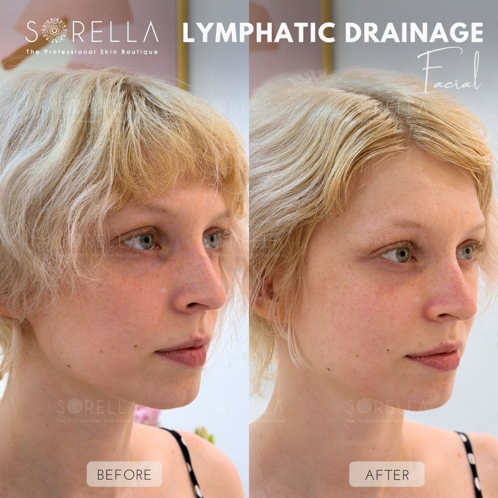 Before and after: Lymphatic Drainage Facial / Thanh Diện at Sorella