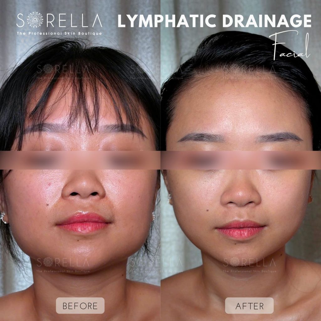 Before and after: Lymphatic Drainage Facial / Thanh Diện at Sorella