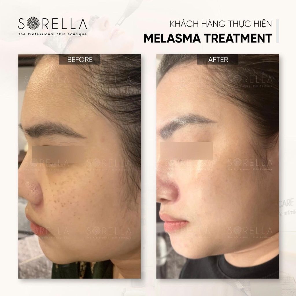 Before and after: Melasma Treatment at Sorella
