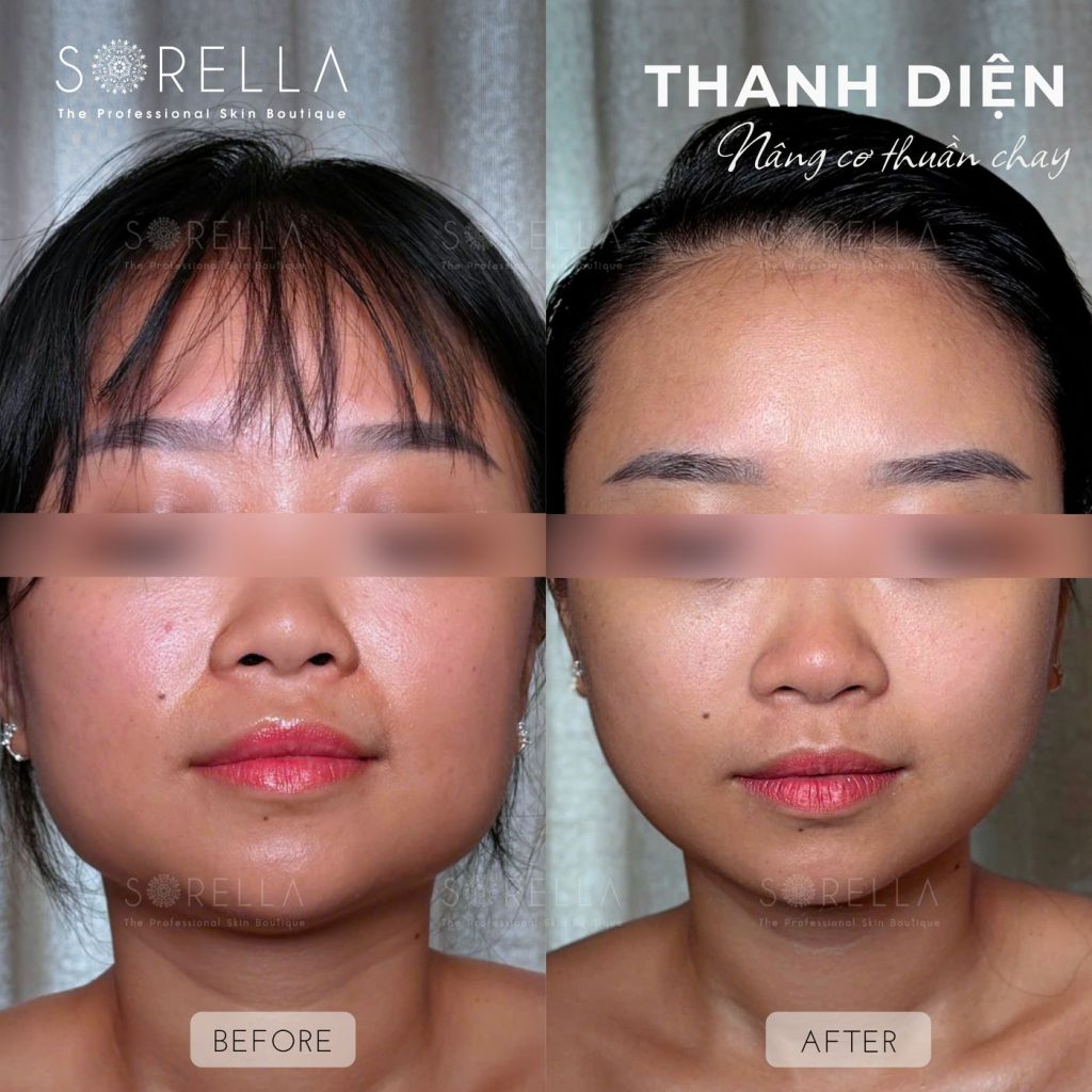 Before and after: Lymphatic Drainage Facial / Thanh Diện at Sorella