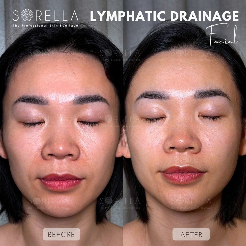 Before and after: Lymphatic Drainage Facial / Thanh Diện at Sorella