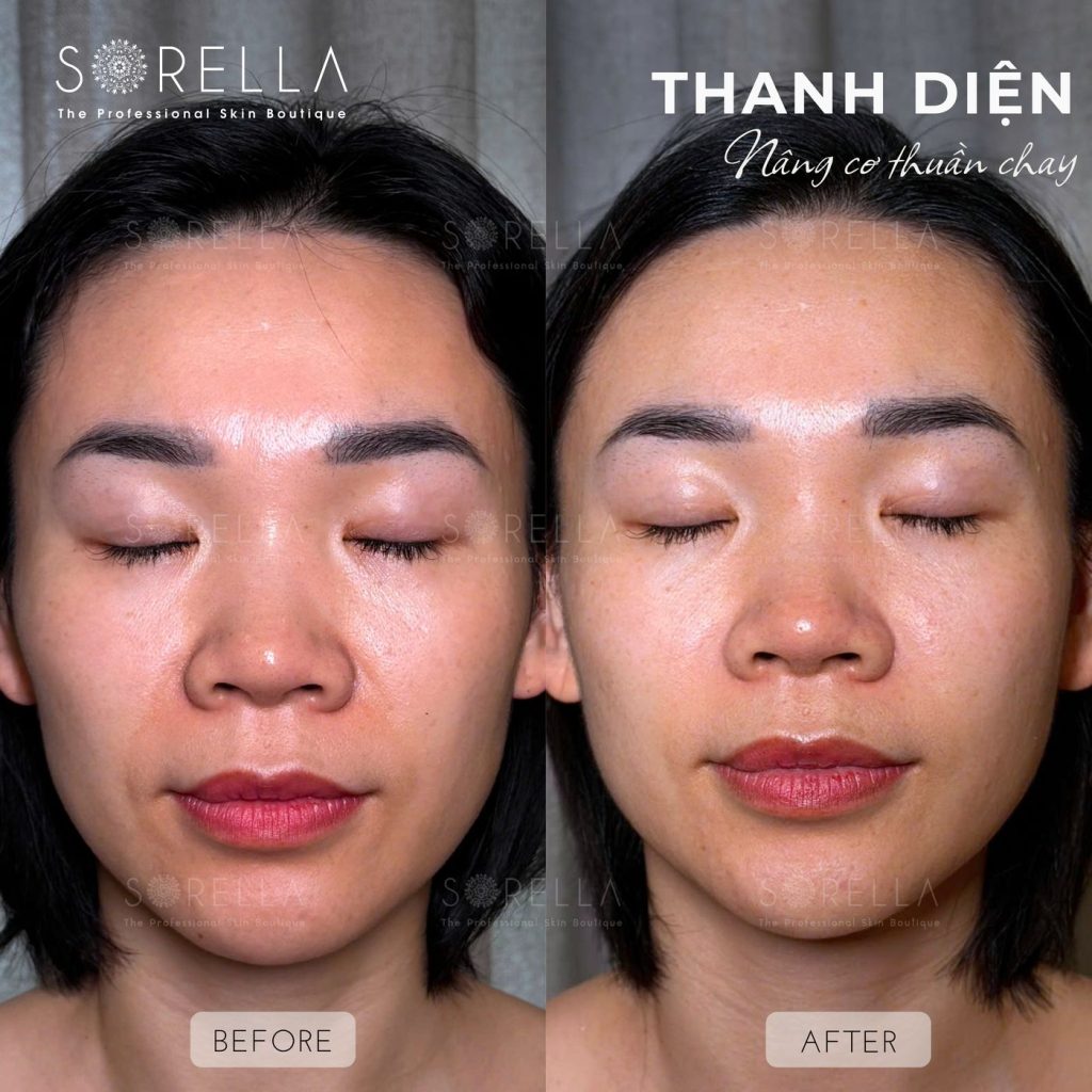 Before and after: Lymphatic Drainage Facial / Thanh Diện at Sorella