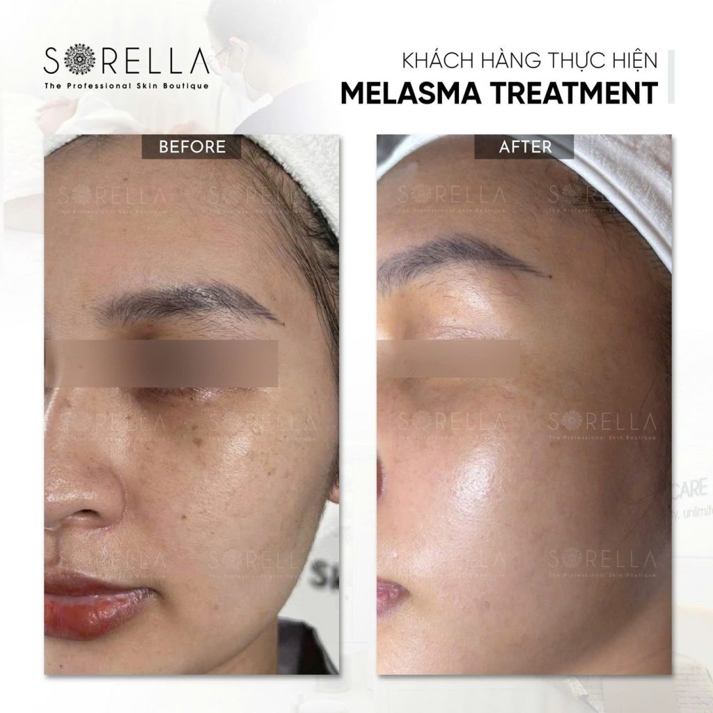 Before and after: Melasma Treatment at Sorella