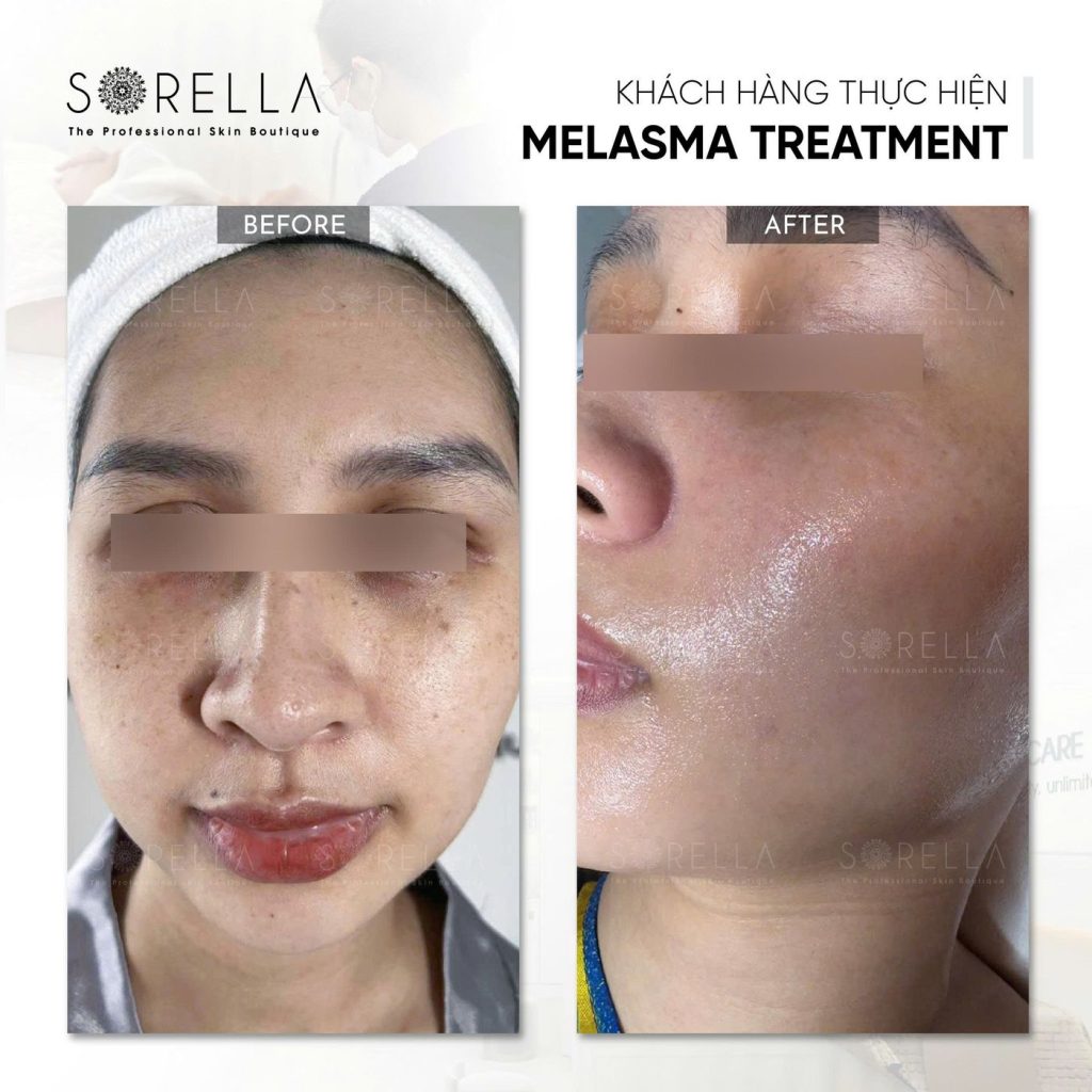 Before and after: Melasma Treatment at Sorella