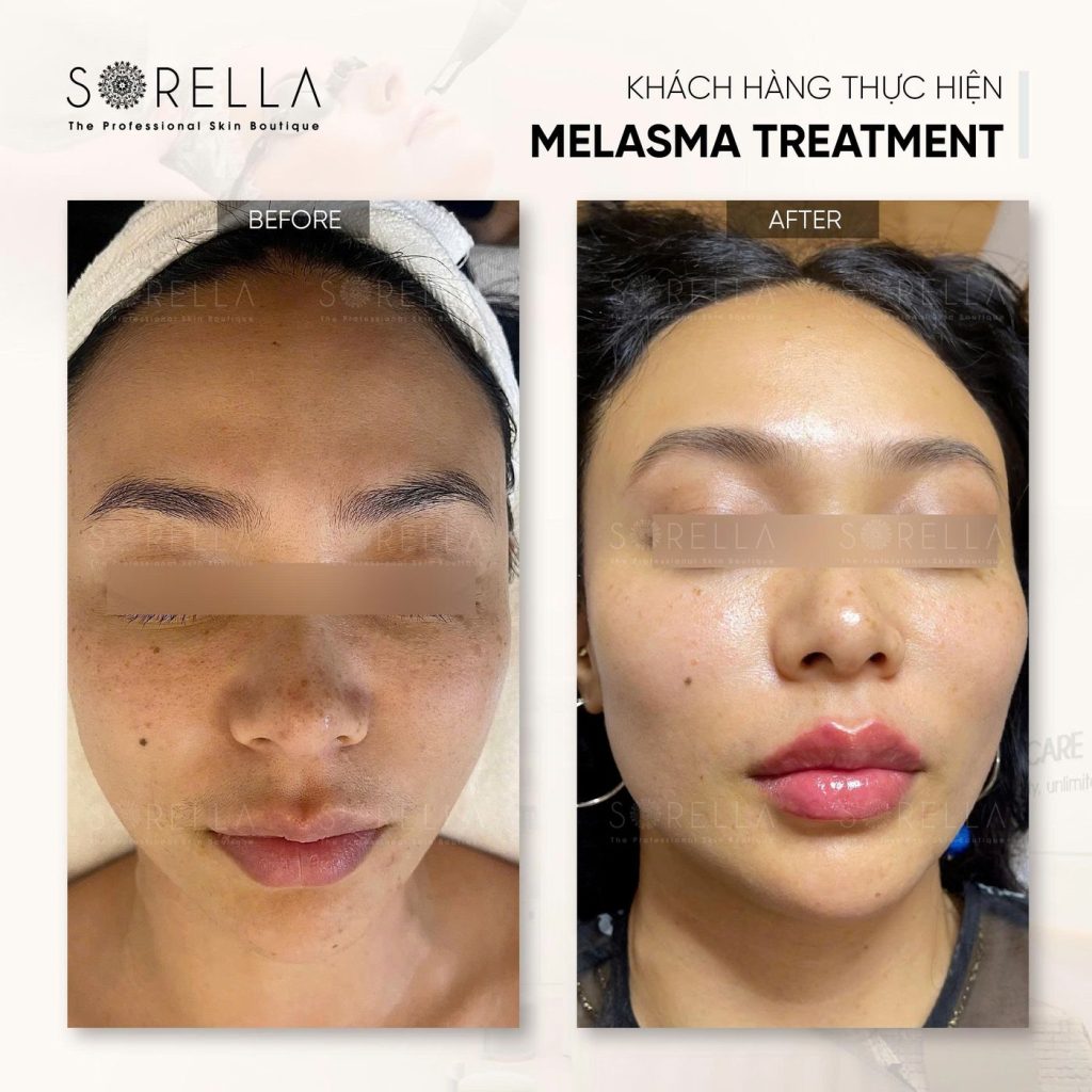 Before and after: Melasma Treatment at Sorella