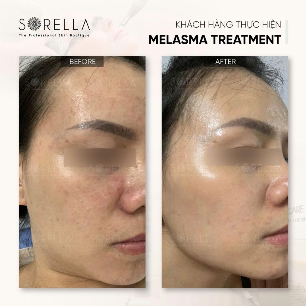 Before and after: Melasma Treatment at Sorella