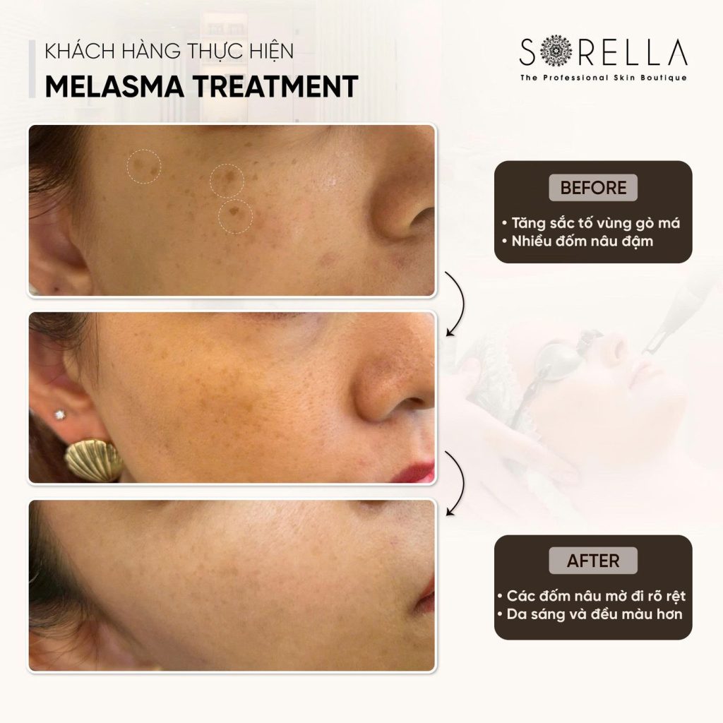 Before and after: Melasma Treatment at Sorella