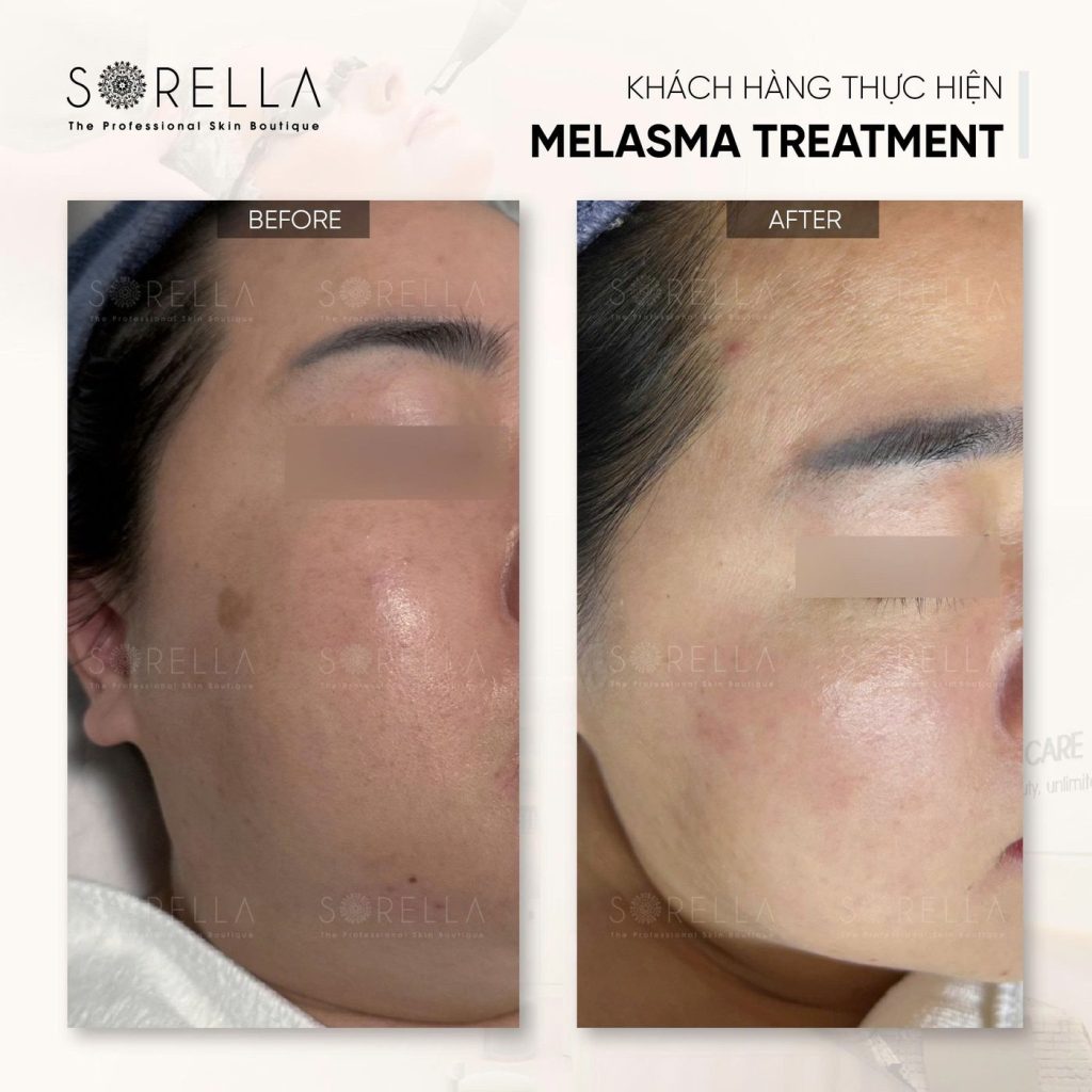 Before and after: Melasma Treatment at Sorella