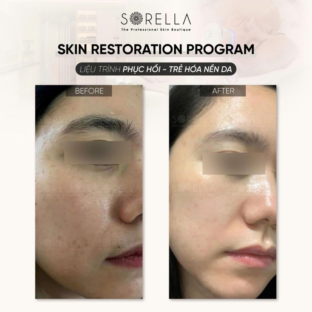 Before and after: Skin Restoration Program at Sorella