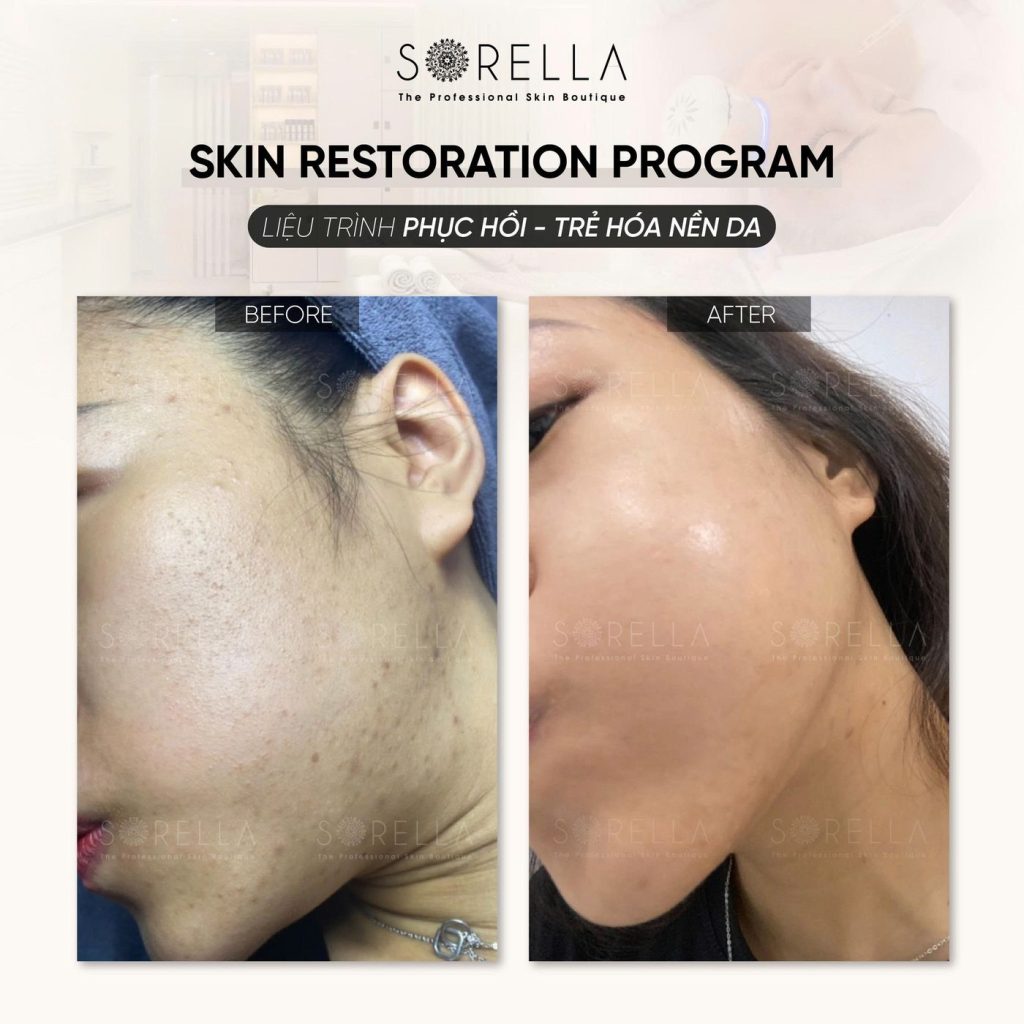 Before and after: Skin Restoration Program at Sorella