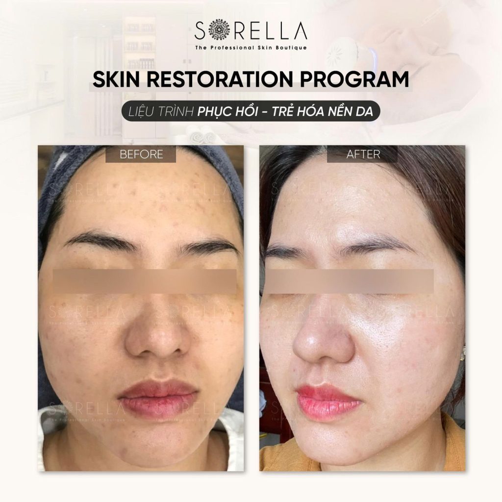 Before and after: Skin Restoration Program at Sorella