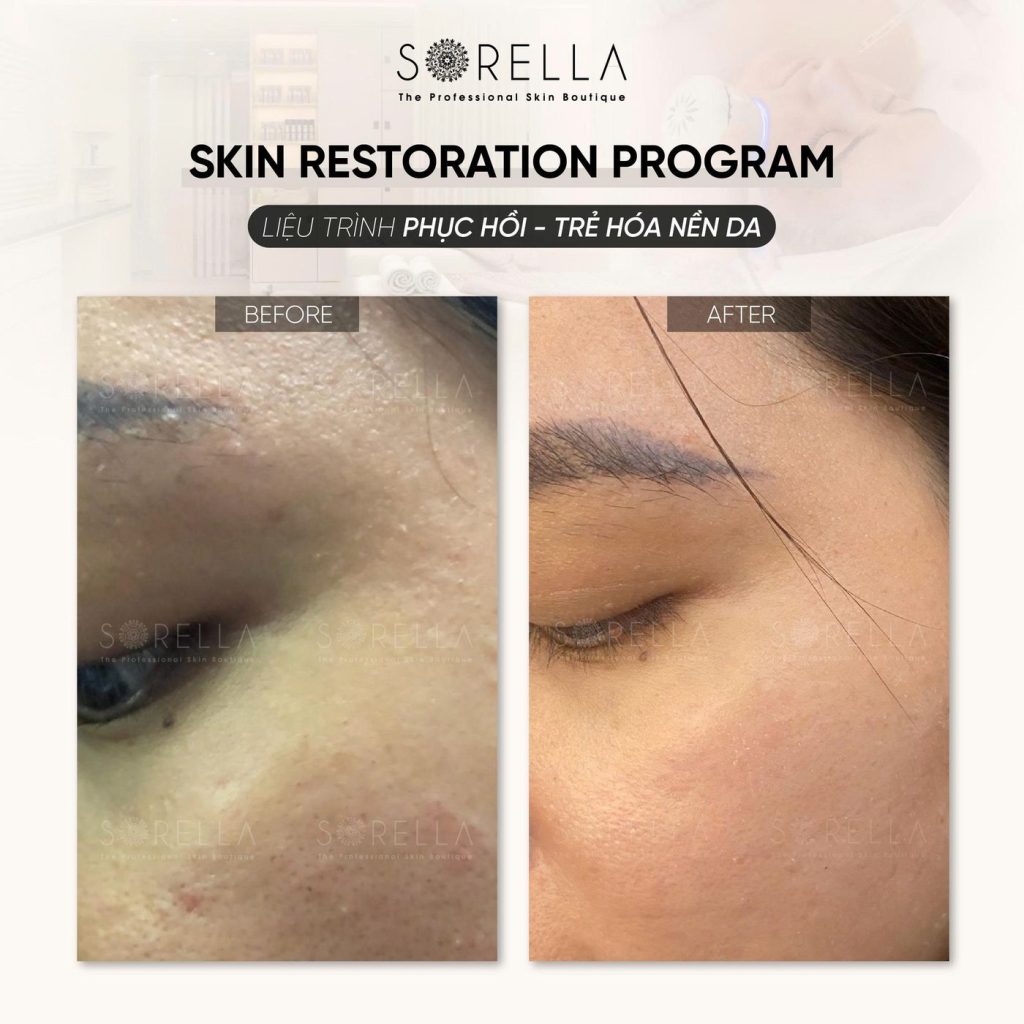 Before and after: Skin Restoration Program at Sorella