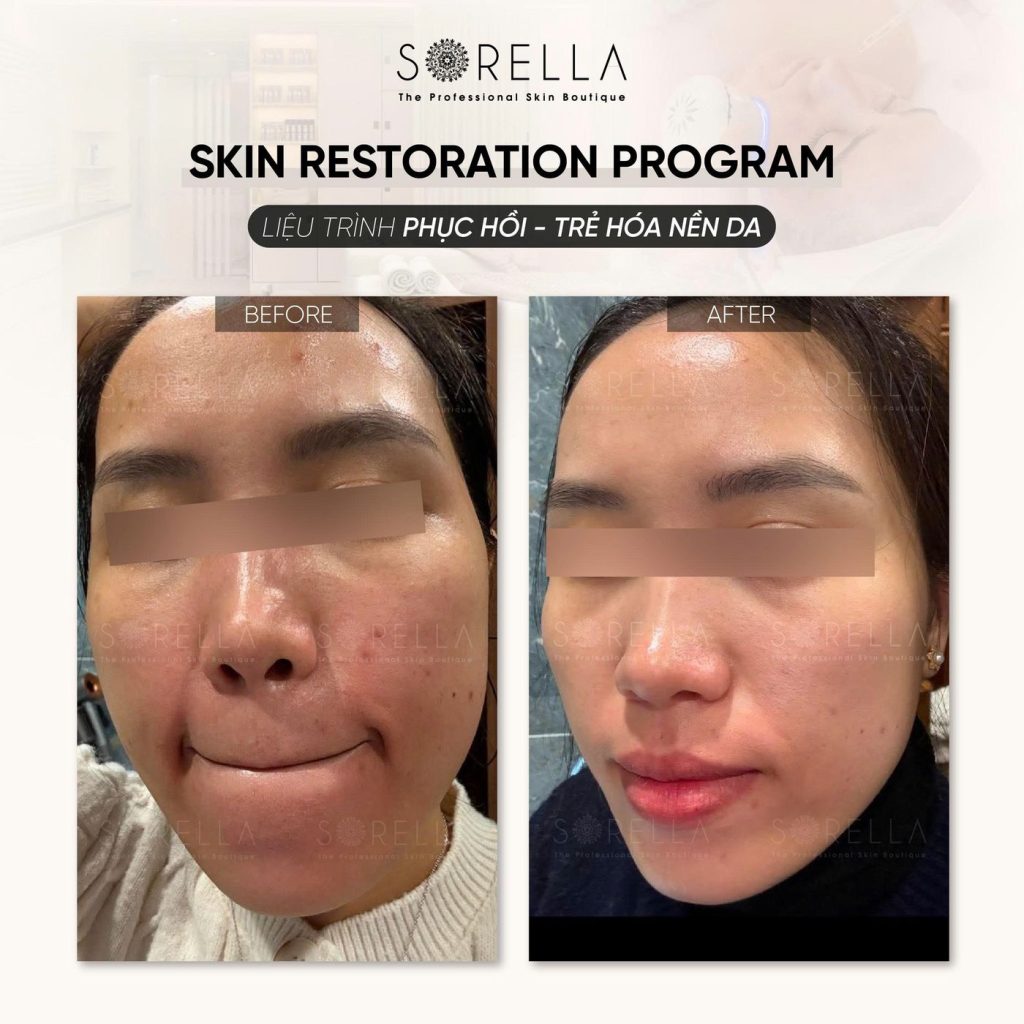 Before and after: Skin Restoration Program at Sorella