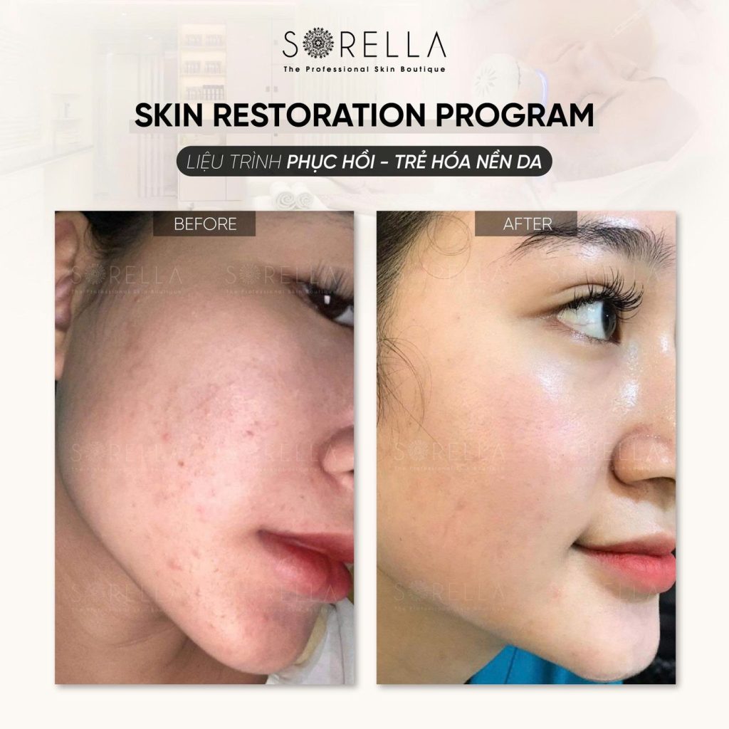 Before and after: Skin Restoration Program at Sorella