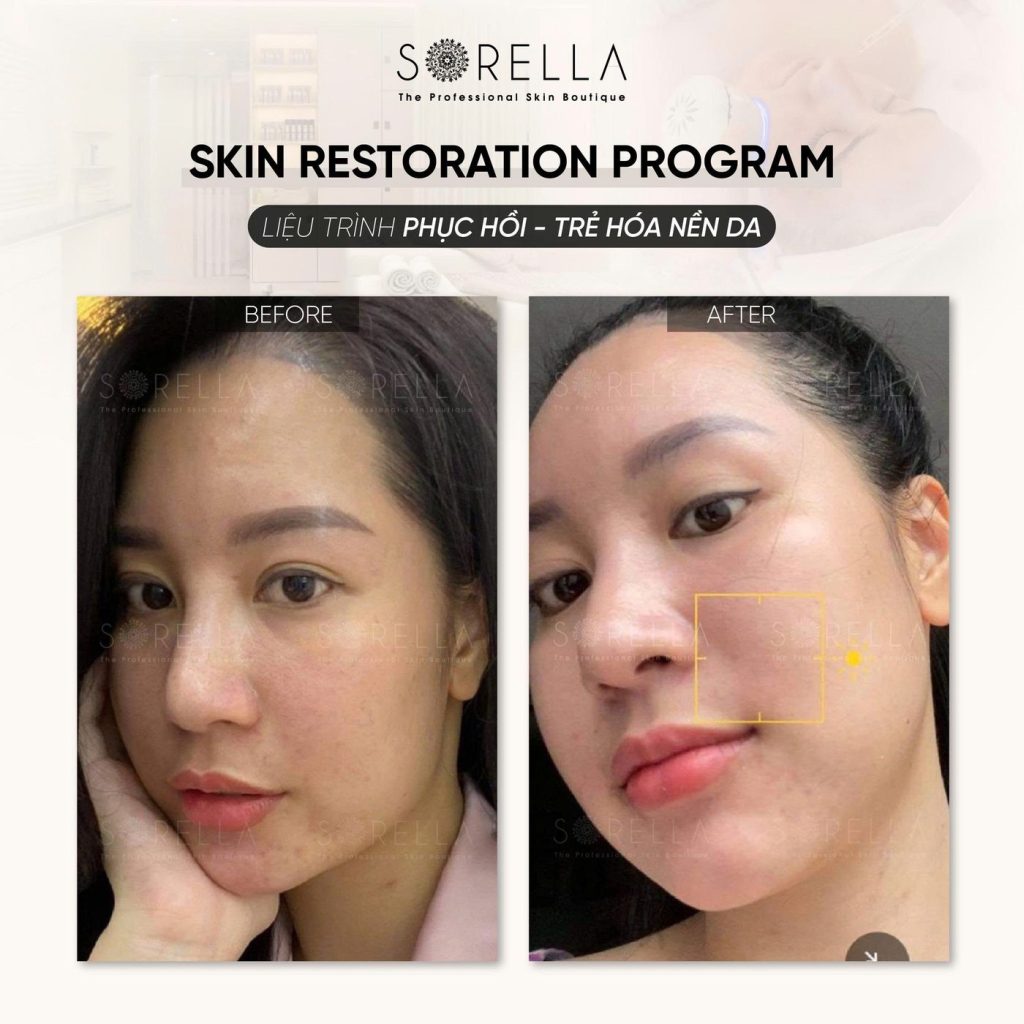Before and after: Skin Restoration Program at Sorella