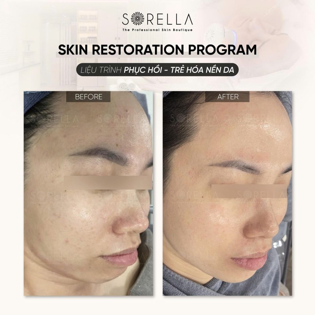 Before and after: Skin Restoration Program at Sorella