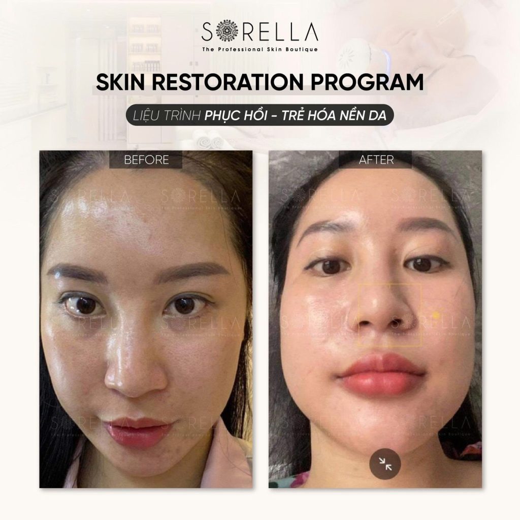 Before and after: Skin Restoration Program at Sorella