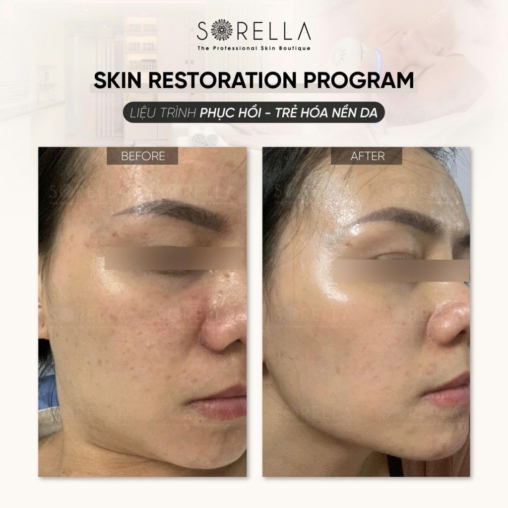 Before and after: Skin Restoration Program at Sorella