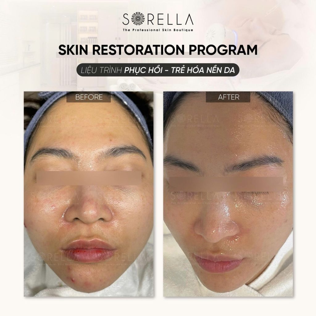 Before and after: Skin Restoration Program at Sorella